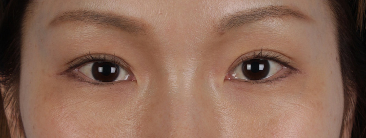 Blepharoplasty Before & After Gallery - Patient 309409 - Image 2
