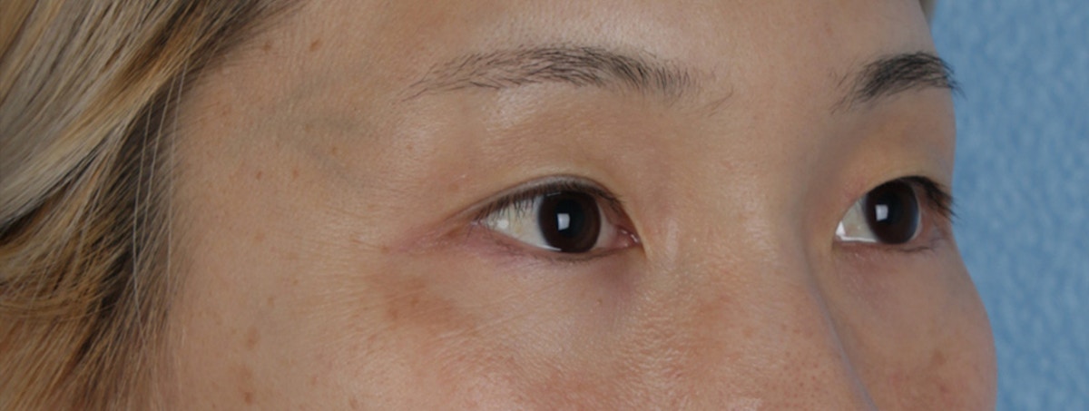 Blepharoplasty Before & After Gallery - Patient 309409 - Image 3