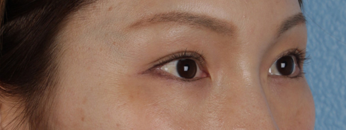 Blepharoplasty Before & After Gallery - Patient 309409 - Image 4