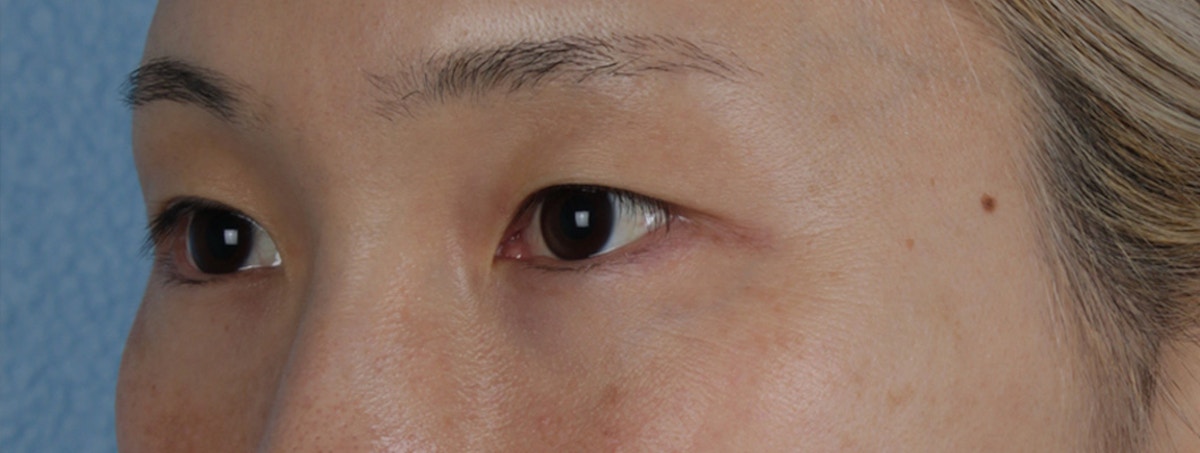 Blepharoplasty Before & After Gallery - Patient 309409 - Image 5