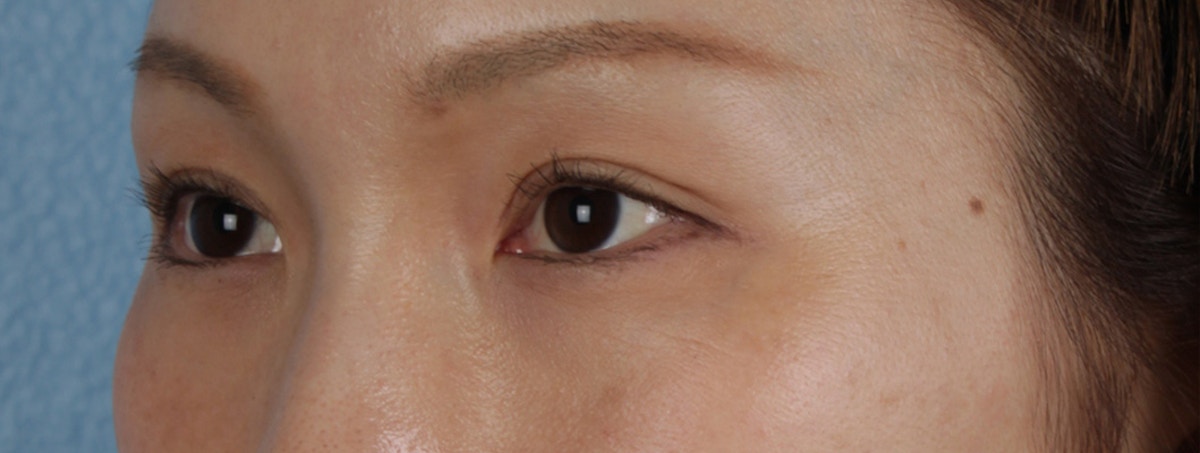 Blepharoplasty Before & After Gallery - Patient 309409 - Image 6