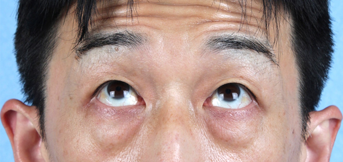 Blepharoplasty Before & After Gallery - Patient 659679 - Image 1