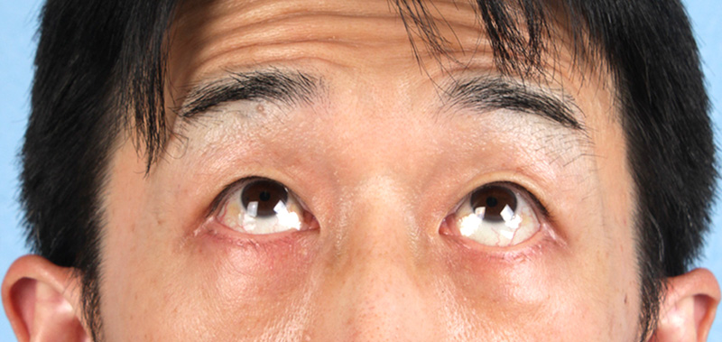 Blepharoplasty Before & After Gallery - Patient 659679 - Image 2