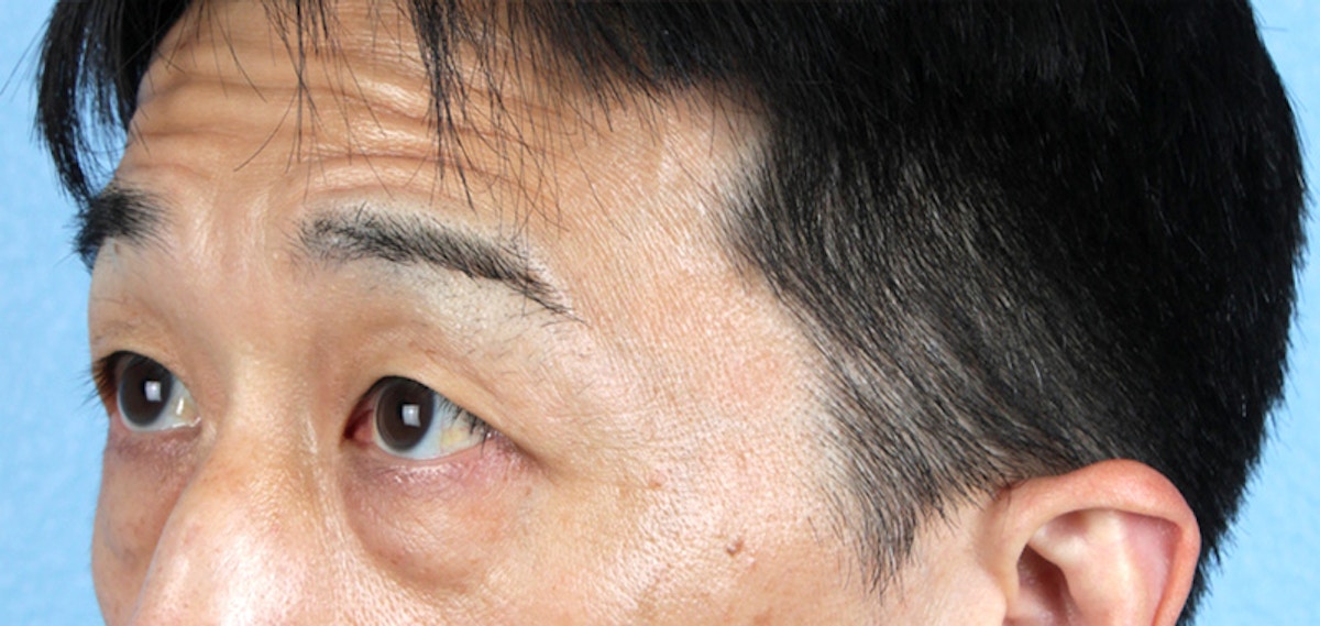 Blepharoplasty Before & After Gallery - Patient 659679 - Image 3