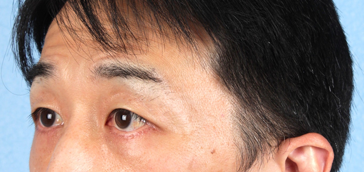Blepharoplasty Before & After Gallery - Patient 659679 - Image 4