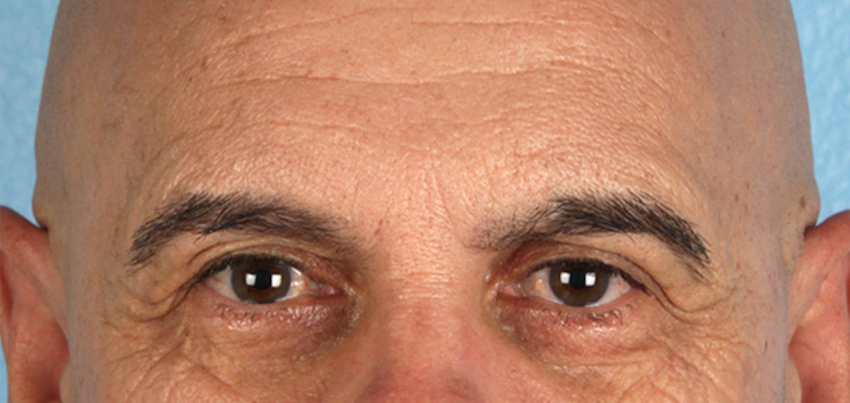 Blepharoplasty Before & After Gallery - Patient 309869 - Image 1