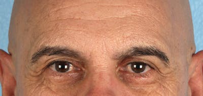 Brow Lift Before & After Gallery - Patient 289270 - Image 1