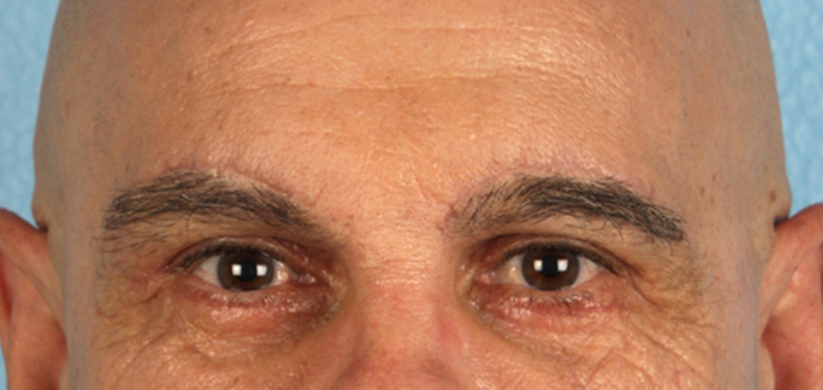 Blepharoplasty Before & After Gallery - Patient 309869 - Image 2
