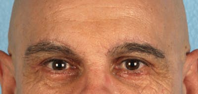 Brow Lift Before & After Gallery - Patient 289270 - Image 2