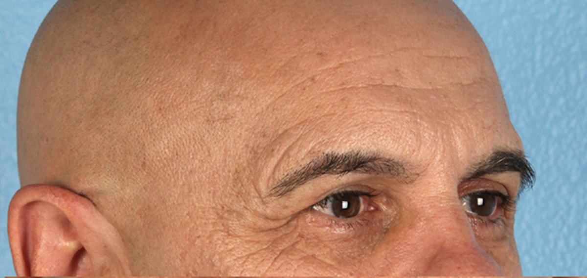 Blepharoplasty Before & After Gallery - Patient 309869 - Image 3