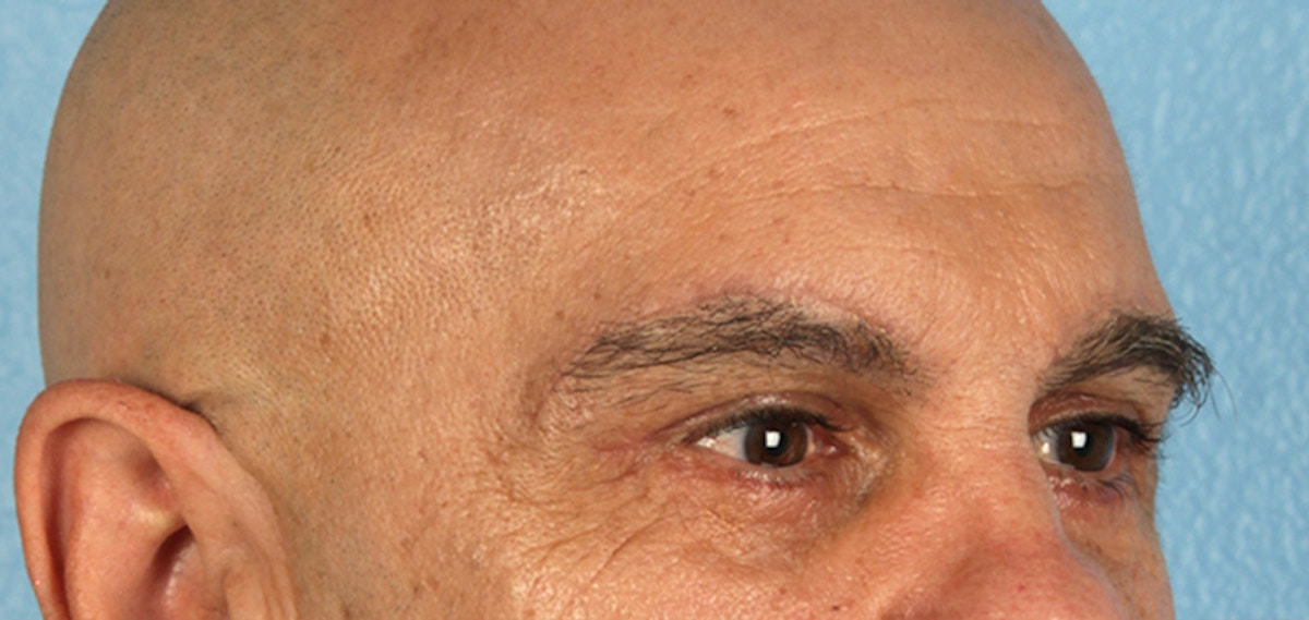 Blepharoplasty Before & After Gallery - Patient 309869 - Image 4