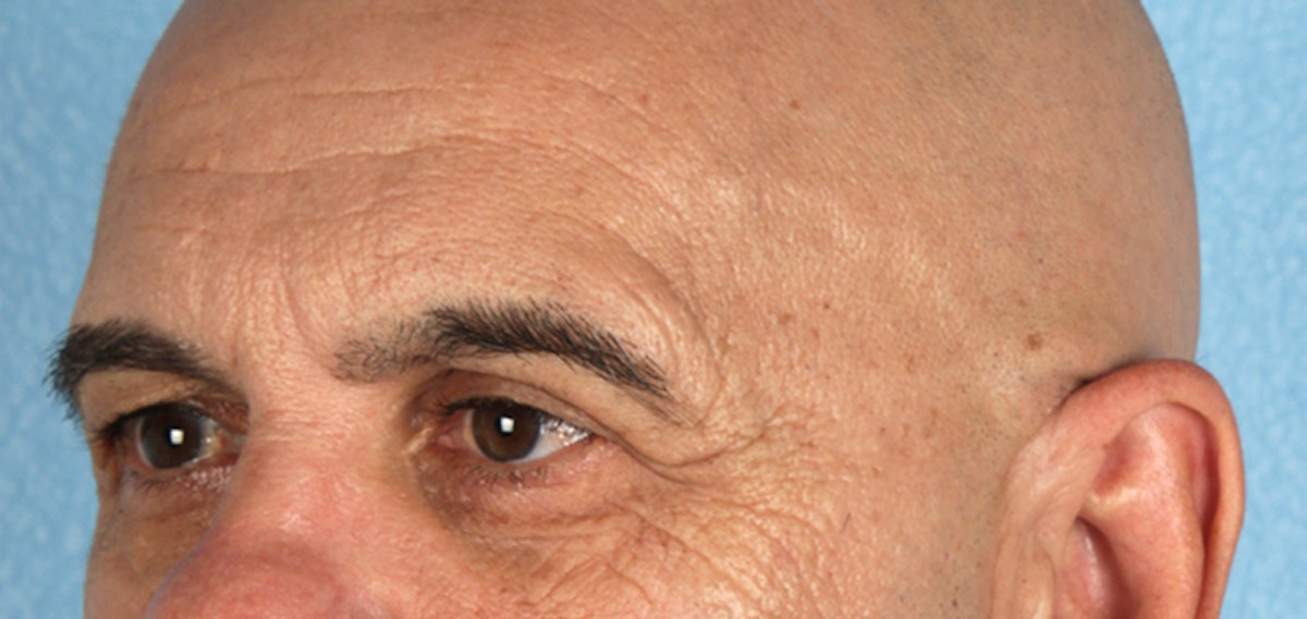 Blepharoplasty Before & After Gallery - Patient 309869 - Image 5