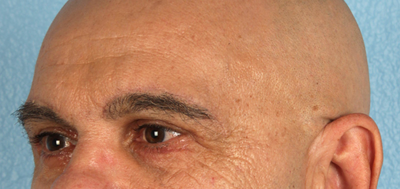 Hidden Patients Before & After Gallery - Patient 421996 - Image 6