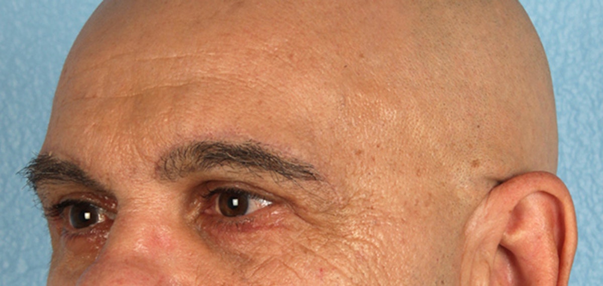 Blepharoplasty Before & After Gallery - Patient 309869 - Image 6