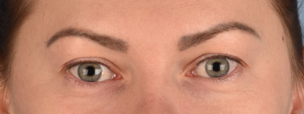 Blepharoplasty Before & After Gallery - Patient 386554 - Image 1