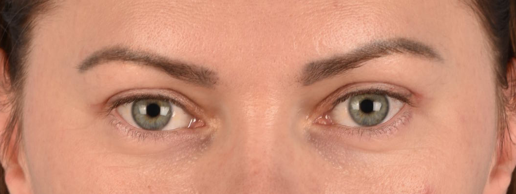 Blepharoplasty Before & After Gallery - Patient 386554 - Image 2