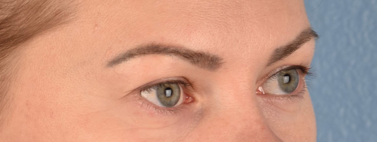 Blepharoplasty Before & After Gallery - Patient 386554 - Image 3