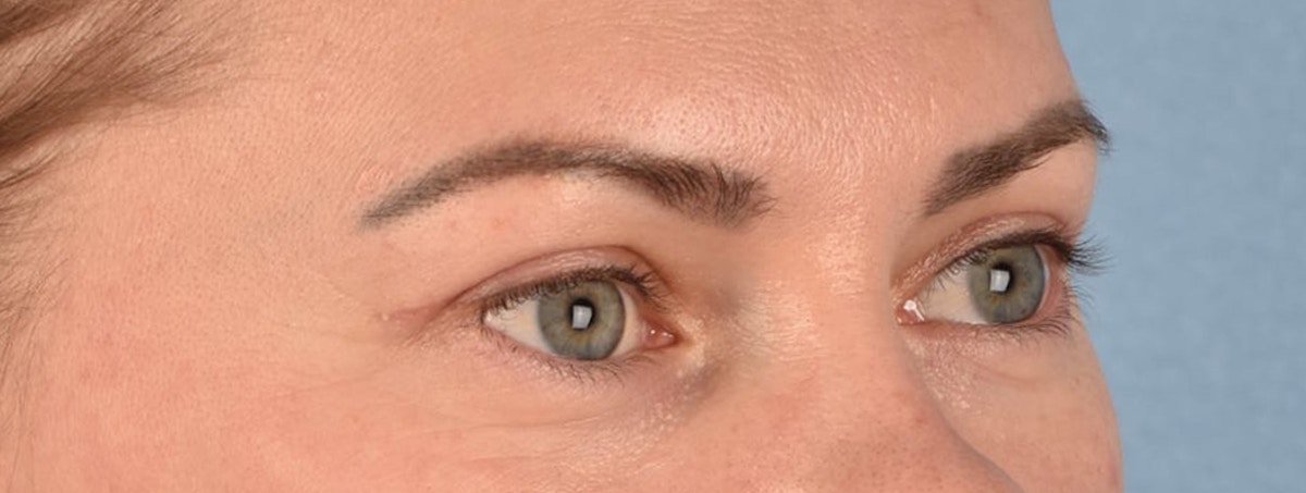 Blepharoplasty Before & After Gallery - Patient 386554 - Image 4
