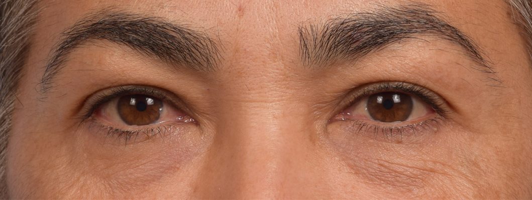 Blepharoplasty Before & After Gallery - Patient 107482 - Image 1