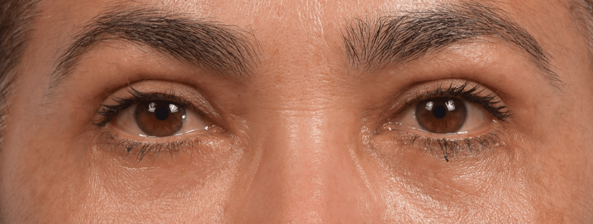 Blepharoplasty Before & After Gallery - Patient 107482 - Image 2