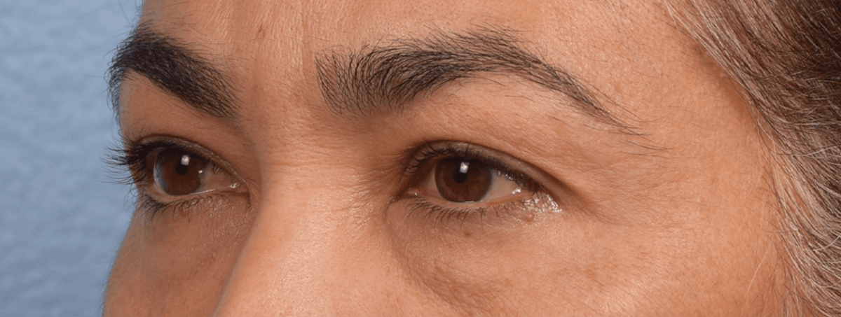 Blepharoplasty Before & After Gallery - Patient 107482 - Image 3