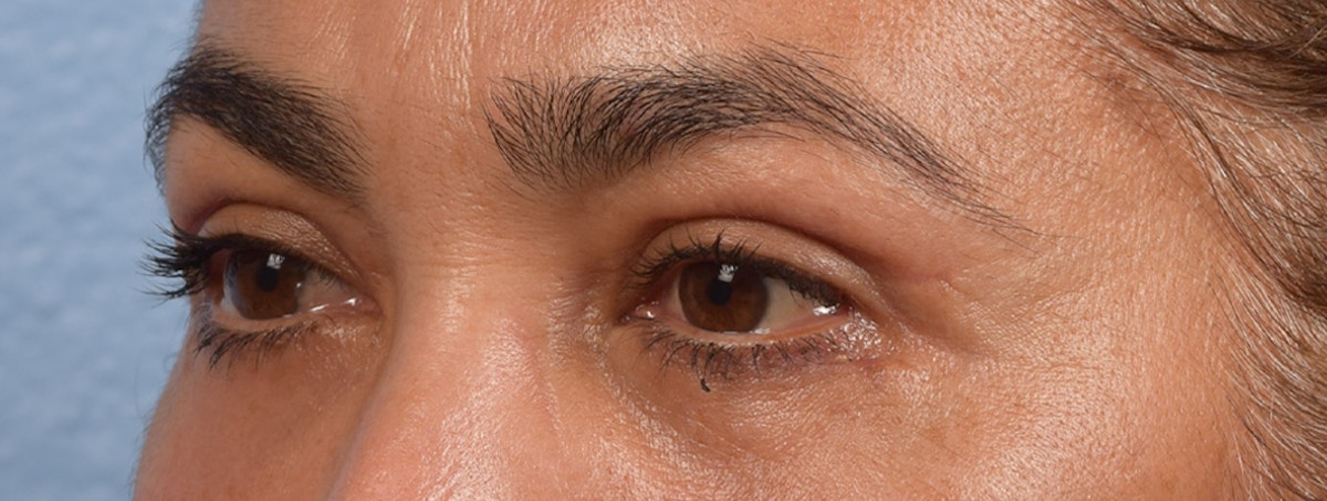 Blepharoplasty Before & After Gallery - Patient 107482 - Image 4