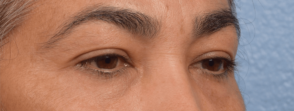 Blepharoplasty Before & After Gallery - Patient 107482 - Image 5