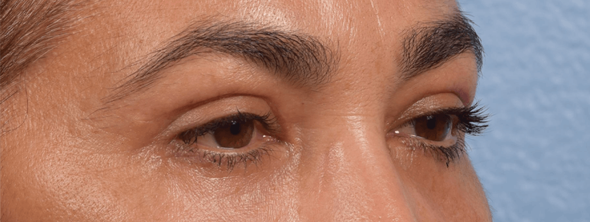 Blepharoplasty Before & After Gallery - Patient 107482 - Image 6