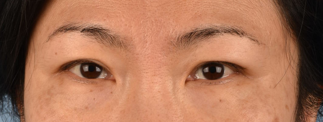 Blepharoplasty Before & After Gallery - Patient 212914 - Image 1