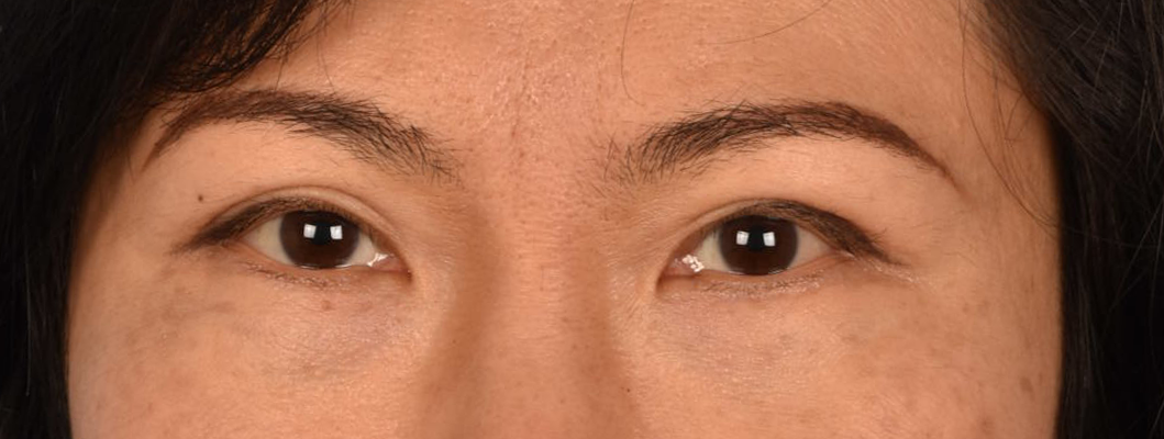 Blepharoplasty Before & After Gallery - Patient 212914 - Image 2