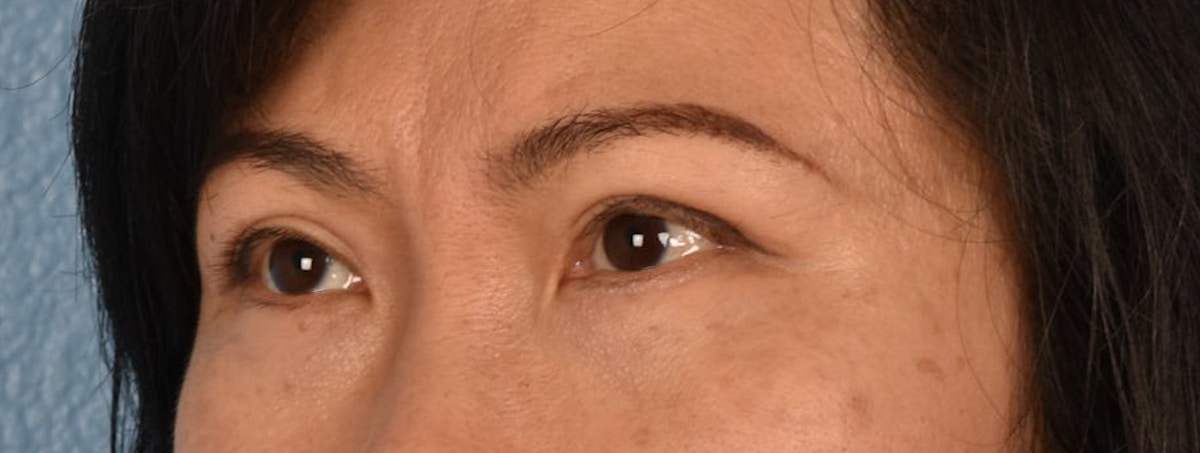 Blepharoplasty Before & After Gallery - Patient 212914 - Image 4