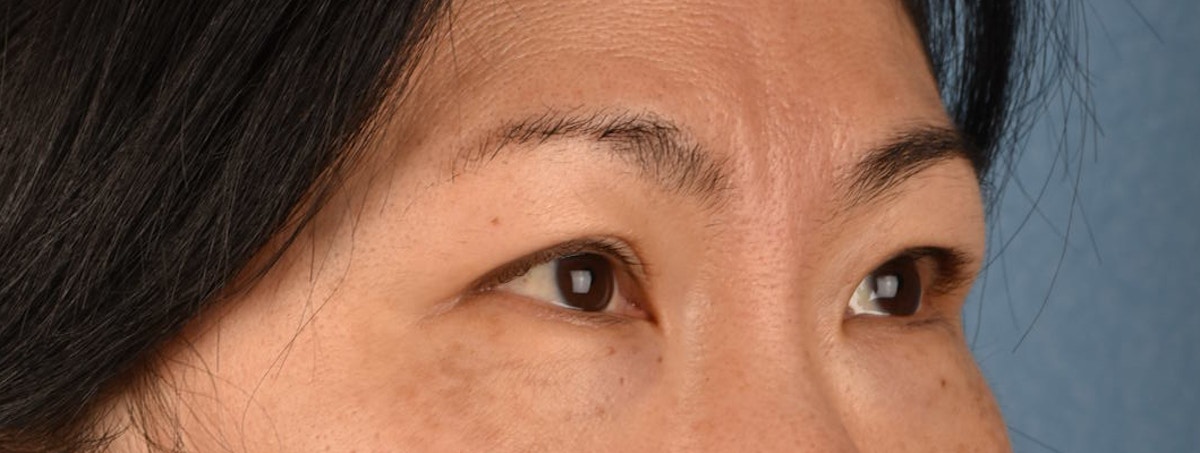 Blepharoplasty Before & After Gallery - Patient 212914 - Image 5