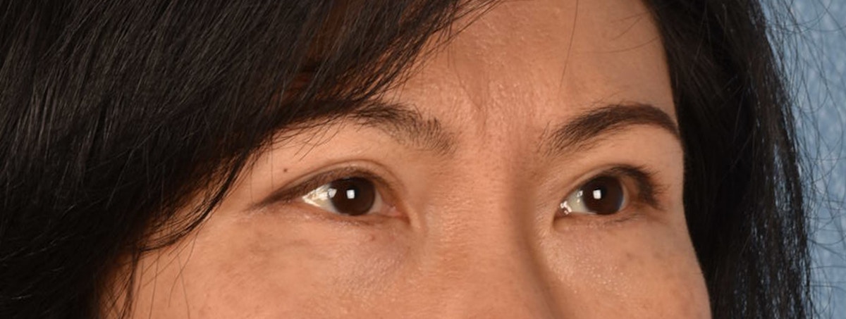 Blepharoplasty Before & After Gallery - Patient 212914 - Image 6