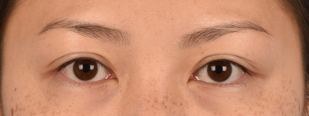 Hidden Patients Before & After Gallery - Patient 136681 - Image 1