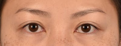 Hidden Patients Before & After Gallery - Patient 136681 - Image 1