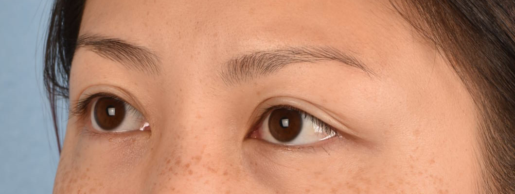 Hidden Patients Before & After Gallery - Patient 136681 - Image 3