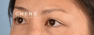 Hidden Patients Before & After Gallery - Patient 136681 - Image 3