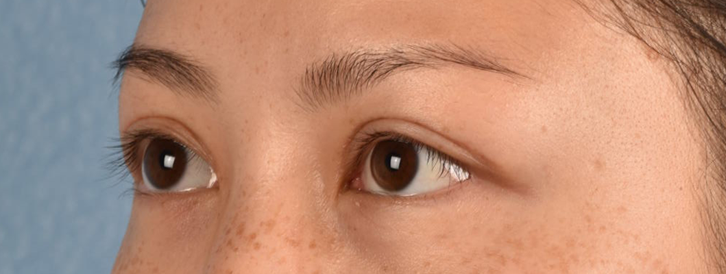 Hidden Patients Before & After Gallery - Patient 136681 - Image 4