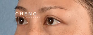 Hidden Patients Before & After Gallery - Patient 136681 - Image 4