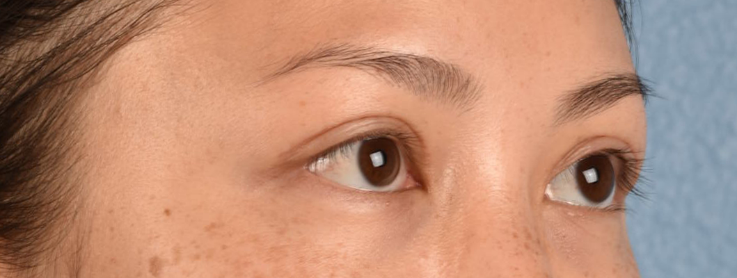 Hidden Patients Before & After Gallery - Patient 136681 - Image 6