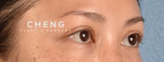 Hidden Patients Before & After Gallery - Patient 136681 - Image 6