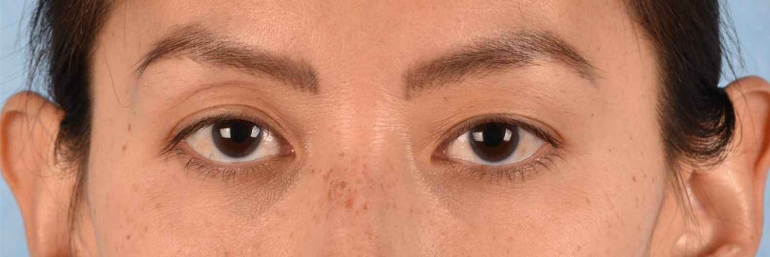 Hidden Patients Before & After Gallery - Patient 295978 - Image 1