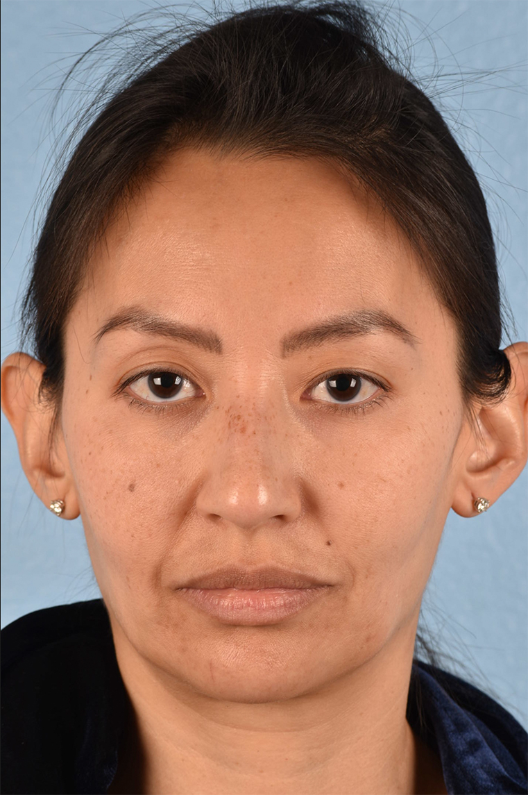 Hidden Patients Before & After Gallery - Patient 295978 - Image 3