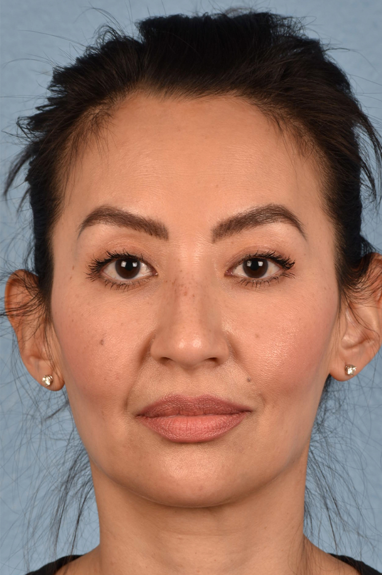 Hidden Patients Before & After Gallery - Patient 295978 - Image 4