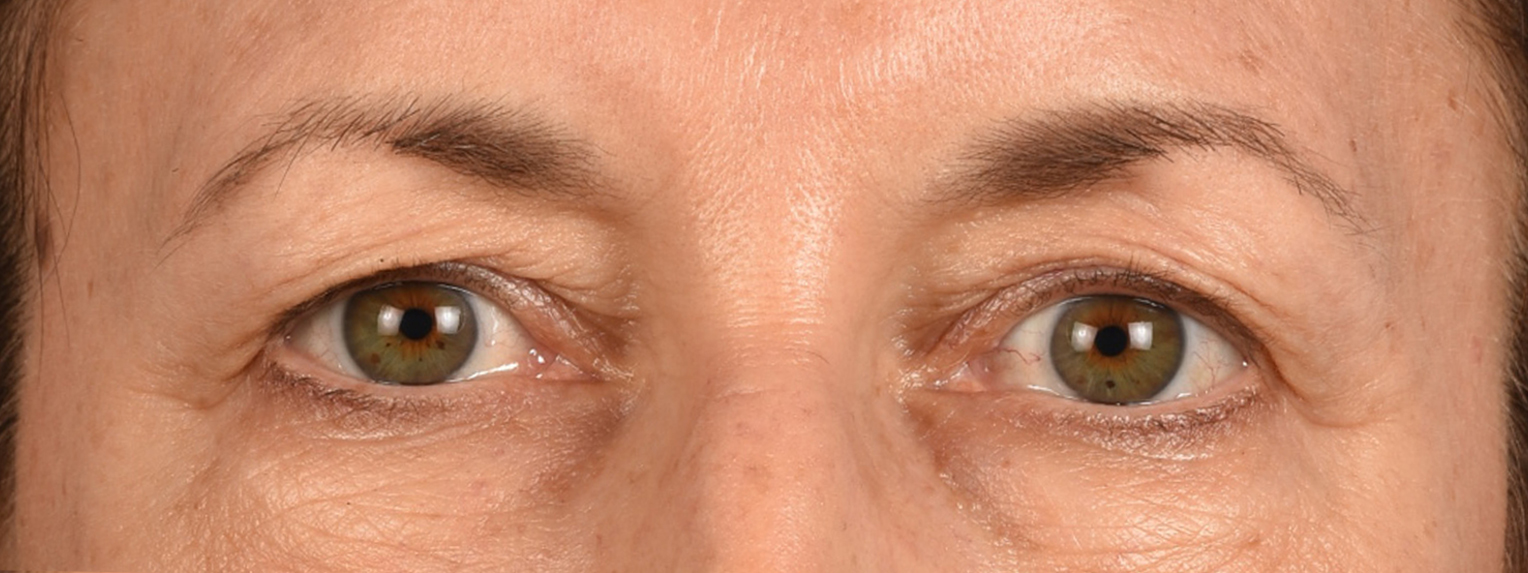 Blepharoplasty Before & After Gallery - Patient 721539 - Image 1