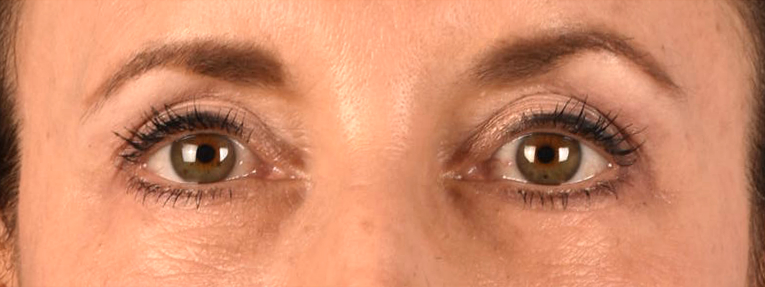 Blepharoplasty Before & After Gallery - Patient 721539 - Image 2