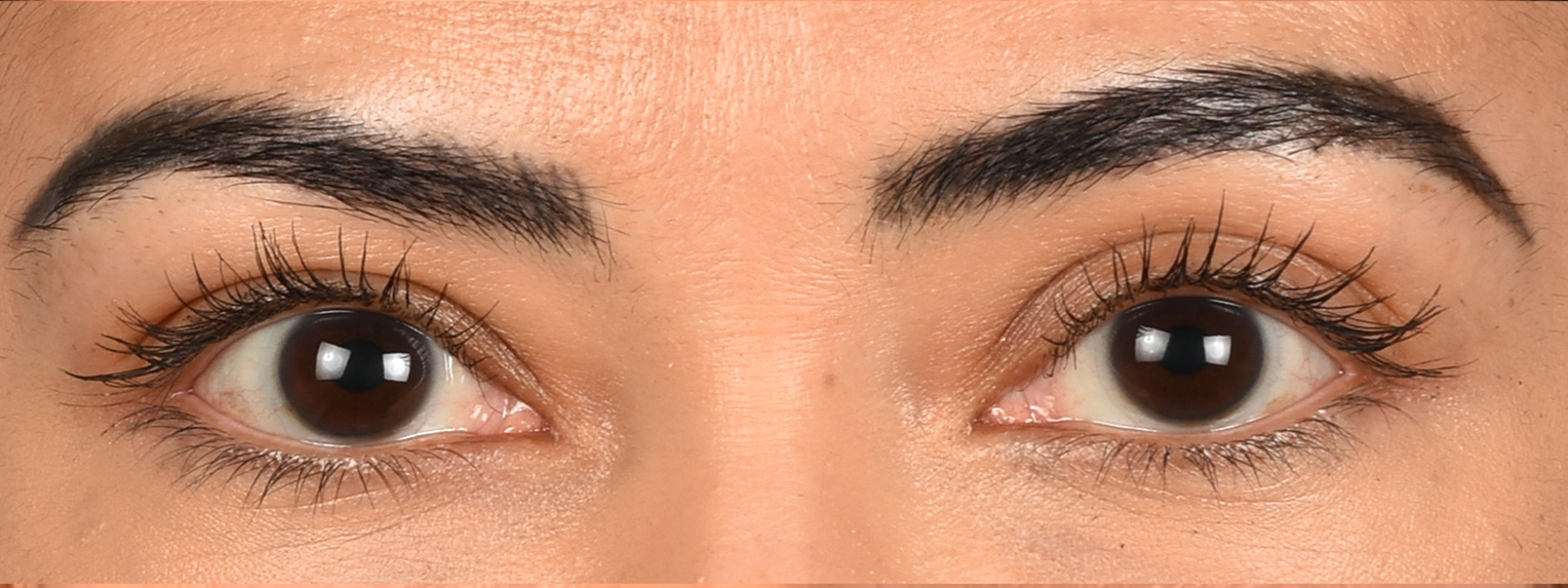 Blepharoplasty Before & After Gallery - Patient 181625 - Image 1