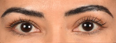 Blepharoplasty Before & After Gallery - Patient 181625 - Image 1