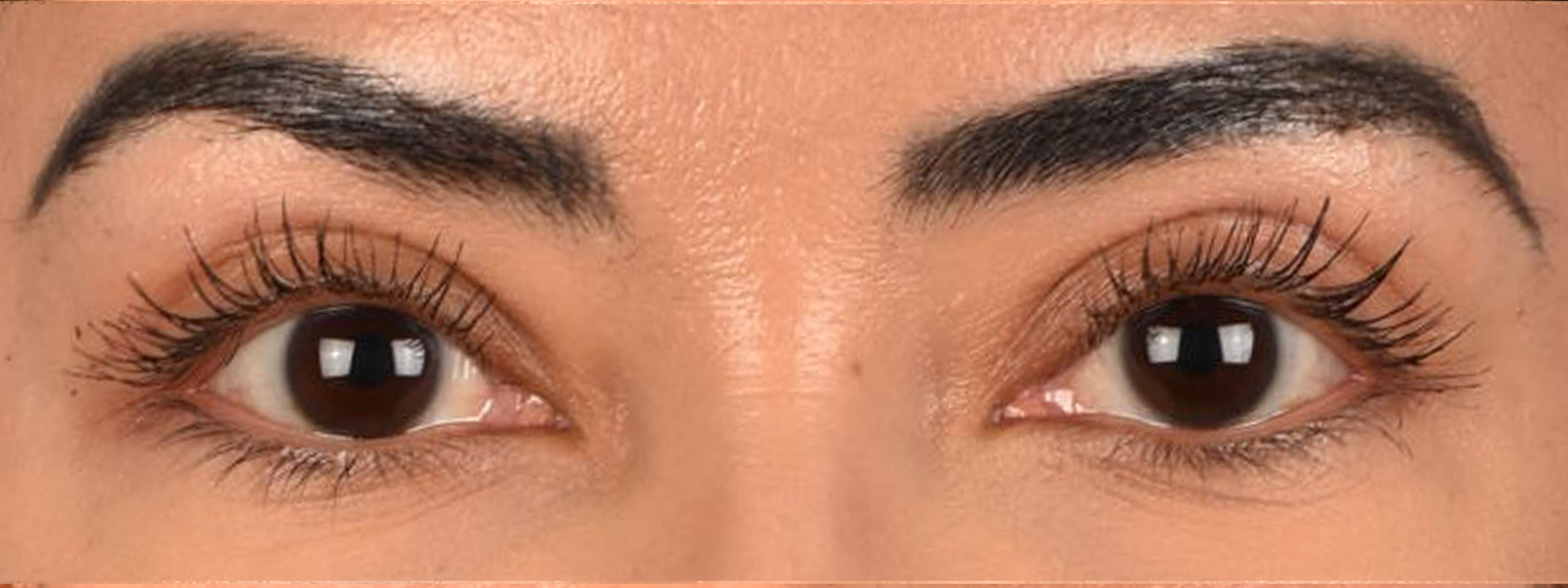Blepharoplasty Before & After Gallery - Patient 181625 - Image 2