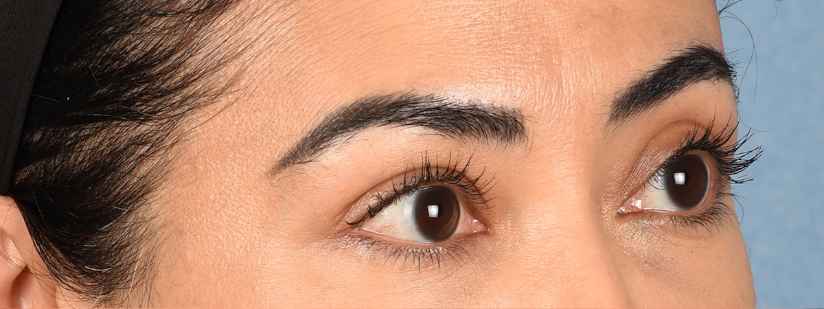 Blepharoplasty Before & After Gallery - Patient 181625 - Image 3